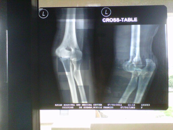 Freak Accident:X-Ray
